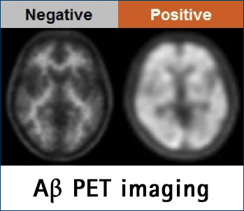 Immagini PET della beta amiloide nella diagnosi della malattia di Alzheimer